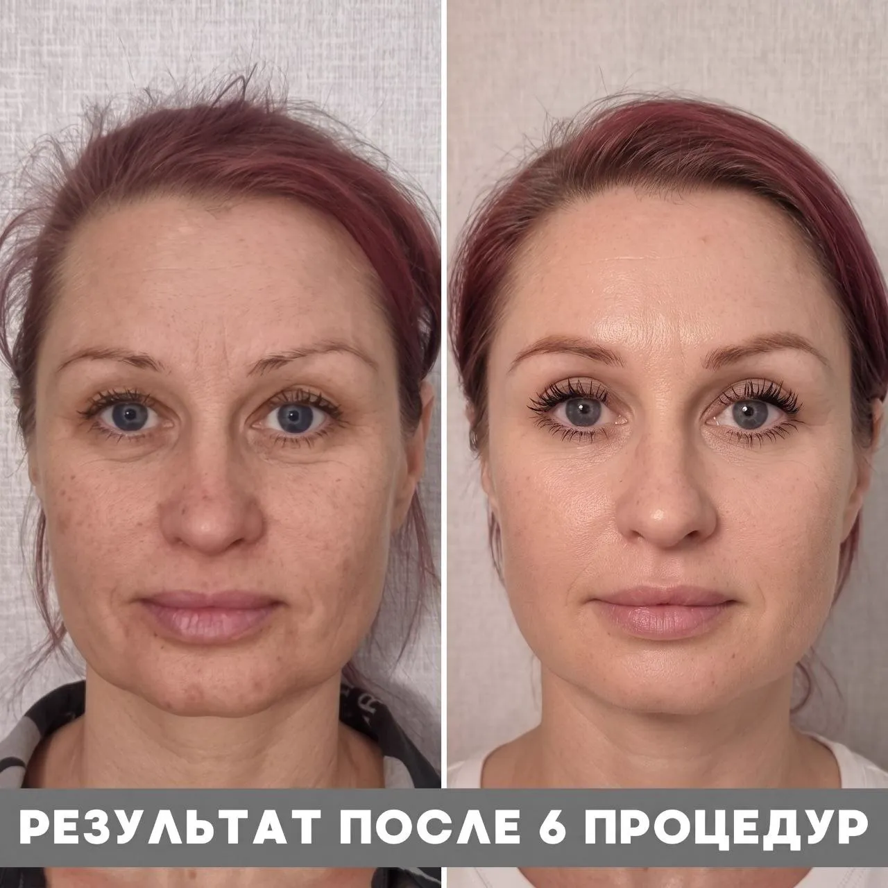 Комплексный нейро-миофасциальный лифтинг лица